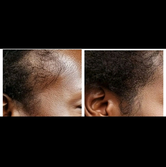 *:New Crown naturale Electric Scalp Massager Hair Oil Applicator Brush Red Light - Picture 16 of 16